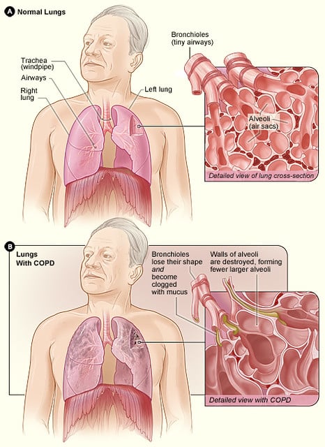 what is the best treatment for copd?